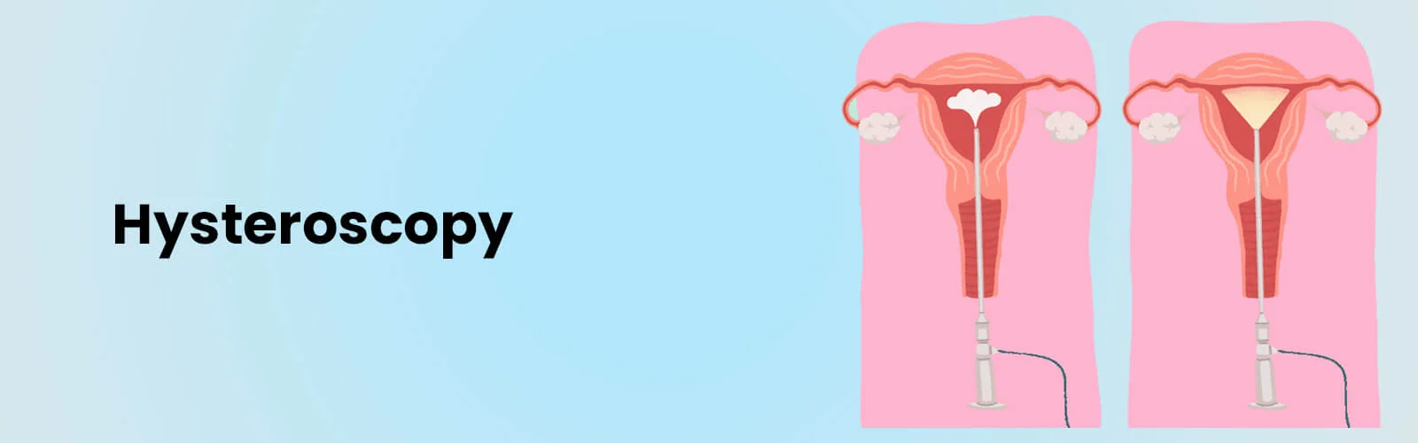 hysteroscopy-banner